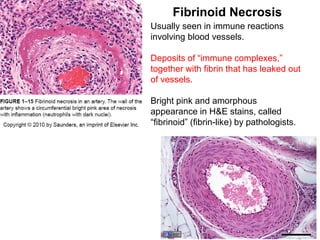 Usually seen in immune reactions
involving blood vessels.
Deposits of “immune complexes,”
together with fibrin that has leaked out
of vessels.
Bright pink and amorphous
appearance in H&E stains, called
“fibrinoid” (fibrin-like) by pathologists.
Fibrinoid Necrosis
 