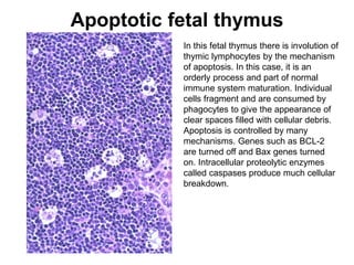 Apoptotic fetal thymus
In this fetal thymus there is involution of
thymic lymphocytes by the mechanism
of apoptosis. In this case, it is an
orderly process and part of normal
immune system maturation. Individual
cells fragment and are consumed by
phagocytes to give the appearance of
clear spaces filled with cellular debris.
Apoptosis is controlled by many
mechanisms. Genes such as BCL-2
are turned off and Bax genes turned
on. Intracellular proteolytic enzymes
called caspases produce much cellular
breakdown.
 