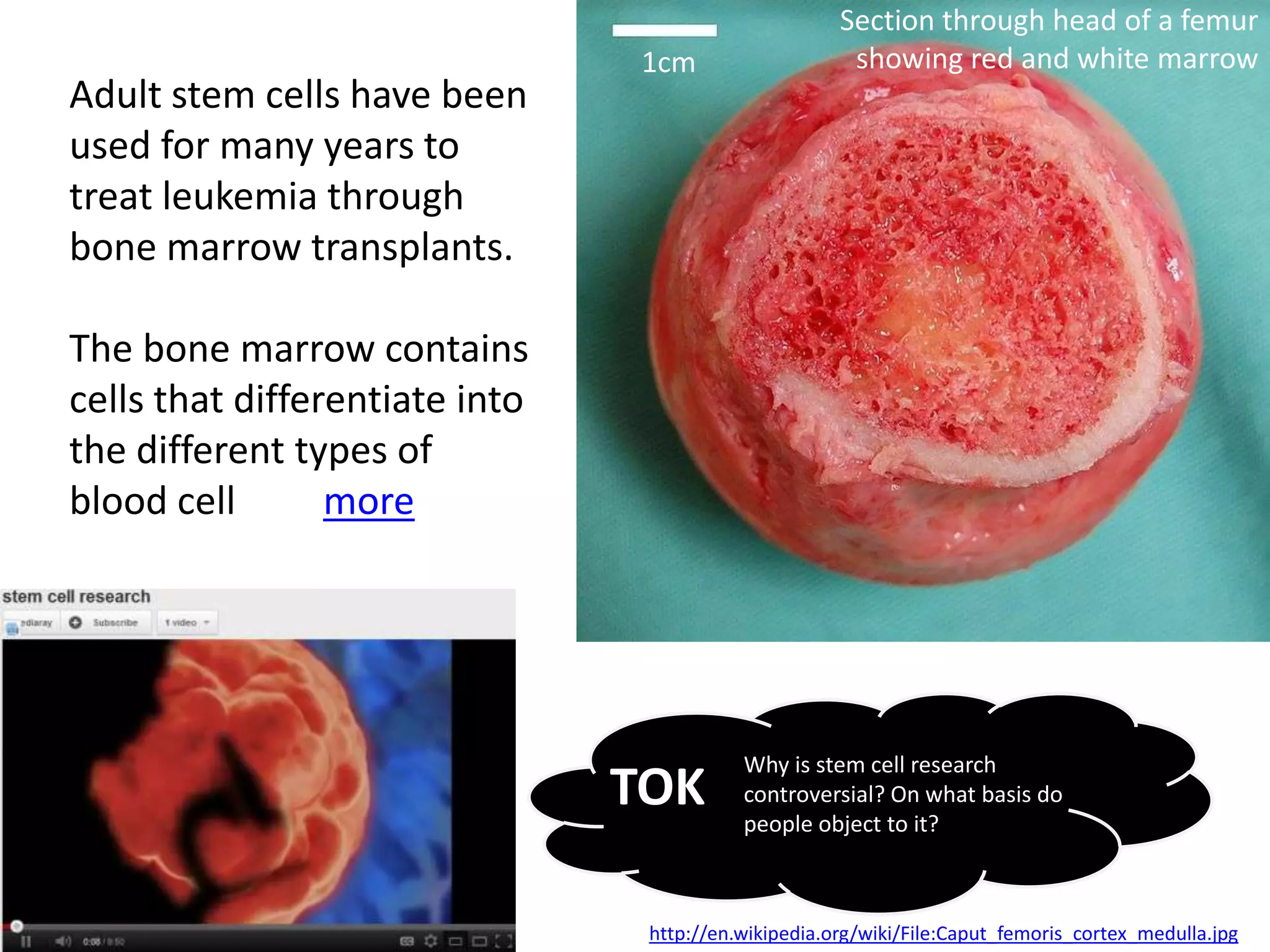 Section through head of a femur
                                1cm                    showing red and white marrow
Adult stem cells have been
used for many years to
treat leukemia through
bone marrow transplants.

The bone marrow contains
cells that differentiate into
the different types of
blood cell       more




                                           Why is stem cell research
                                TOK        controversial? On what basis do
                                           people object to it?



                                 http://en.wikipedia.org/wiki/File:Caput_femoris_cortex_medulla.jpg
 