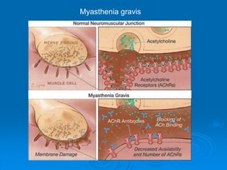 Myasthenia gravis
 