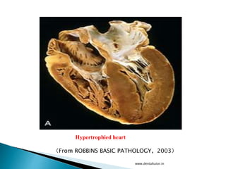 Hypertrophied heart
（From ROBBINS BASIC PATHOLOGY，2003）
www.dentaltutor.in
 