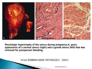 Physiologic hypertrophy of the uterus during pregnancy.A, gross
appearance of a normal uterus (right) and a gravid uterus (left) that was
removed for postpartum bleeding,
Normal uterus gravid uterus
（From ROBBINS BASIC PATHOLOGY，2003）
www.dentaltutor.in
 