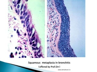Squamous metaplasia in bronchitis
（offered by Prof.Orr）
www.dentaltutor.in
 