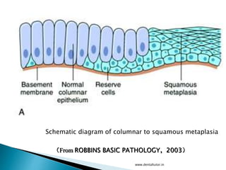Schematic diagram of columnar to squamous metaplasia
（From ROBBINS BASIC PATHOLOGY，2003）
www.dentaltutor.in
 