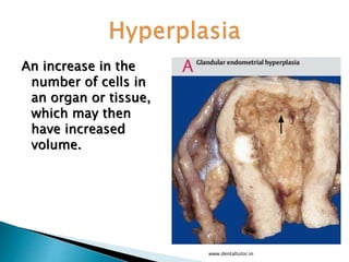 An increase in the
number of cells in
an organ or tissue,
which may then
have increased
volume.
www.dentaltutor.in
 