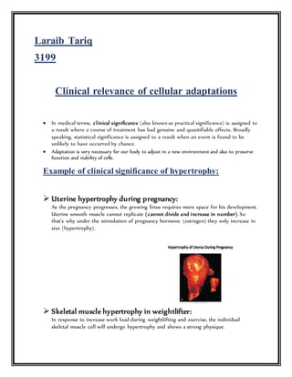 Laraib Tariq
3199
Clinical relevance of cellular adaptations
 In medical terms, clinical significance (also known as practical significance) is assigned to
a result where a course of treatment has had genuine and quantifiable effects. Broadly
speaking, statistical significance is assigned to a result when an event is found to be
unlikely to have occurred by chance.
 Adaptation is very necessary for our body to adjust in a new environment and also to preserve
function and viability of cells.
Example of clinical significance of hypertrophy:
 Uterine hypertrophy during pregnancy:
As the pregnancy progresses, the growing fetus requires more space for his development.
Uterine smooth muscle cannot replicate (cannot divide and increase in number). So
that’s why under the stimulation of pregnancy hormone (estrogen) they only increase in
size (hypertrophy).
 Skeletal muscle hypertrophy in weightlifter:
In response to increase work load during weightlifting and exercise, the individual
skeletal muscle cell will undergo hypertrophy and shows a strong physique.
 