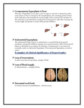  Compensatory hyperplasia in liver:
This type of hyperplasia occur when a part of organ is removed or diseased e.g when
some portion of liver is removed in the transplantation, the remaining portion of liver
starts replication and eventually the normal weight of liver restored. The stimulus for
this restoration is growth factors, produced by remaining liver cells. After restoring the
normal weight, the growth is turned off by growth inhibitors.
 Endometrial hyperplasia:
The endometrial lining of uterus is maintained at a normal thickness by growth
stimulatory and growth inhibitory pituitary and ovarian hormones. When this hormonal
balance is disturbed by any disease, the thickness of endometrium is increased and
eventually results in endometrial hyperplasia. This endometrial hyperplasia can lead to
cancer.
Examples of clinical significance of hypertrophy:
 Loss of innervations:
In polio virus, loss of innervations, atrophy of limb.
 Loss of blood supply:
In atherosclerosis……..atrophy of brain.
 Decreased work load:
In fracture, because of immobilization, of brain occurs.
 