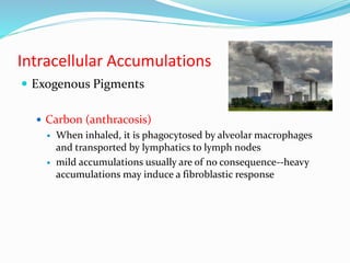 Intracellular Accumulations
 Exogenous Pigments
 Carbon (anthracosis)
 When inhaled, it is phagocytosed by alveolar macrophages
and transported by lymphatics to lymph nodes
 mild accumulations usually are of no consequence--heavy
accumulations may induce a fibroblastic response
 