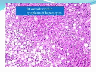fat vacuoles within
cytoplasm of hepatocytes
 