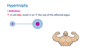 Hypertrophy
• Definition:
↑ in cell size, result in an ↑ the size of the affected organ.
 