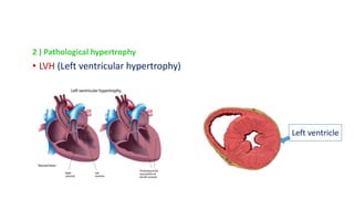 2 ) Pathological hypertrophy
• LVH (Left ventricular hypertrophy)
Left ventricle
 