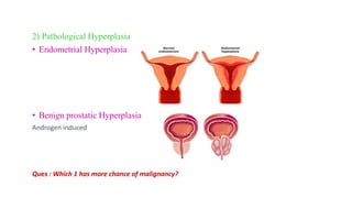 2) Pathological Hyperplasia
• Endometrial Hyperplasia
• Benign prostatic Hyperplasia
Androgen induced
Ques : Which 1 has more chance of malignancy?
 