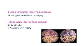 Loss of innervation (Denervation atrophy) -
damage to nerve leads to atrophy.
↓ Blood supply- due to arterial occlusion-
Senile atrophy
Progressive brain atrophy.
 