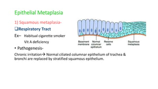 Epithelial Metaplasia
1) Squamous metaplasia-
Respiratory Tract
Ex– Habitual cigarette smoker
Vit A deficiency
• Pathogenesis-
Chronic irritation Normal ciliated columnar epithelium of trachea &
bronchi are replaced by stratified squamous epithelium.
 