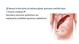 Stones in the ducts of salivary gland, pancreas and bile duct
• Chronic irritation
Secretory columnar epithelium are
replaced by stratified squamous epithelium.
 