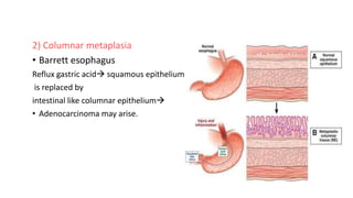 2) Columnar metaplasia
• Barrett esophagus
Reflux gastric acid squamous epithelium
is replaced by
intestinal like columnar epithelium
• Adenocarcinoma may arise.
 
