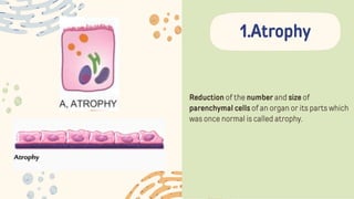 Reduction of the number and size of
parenchymal cells of an organ or its parts which
was once normal is called atrophy.
1.Atrophy
 