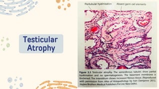 Testicular
Atrophy
 