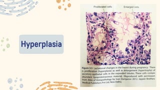 Hyperplasia
 