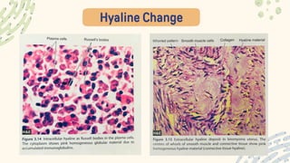 Hyaline Change
 