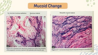 Mucoid Change
 