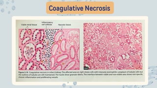 Coagulative Necrosis
 