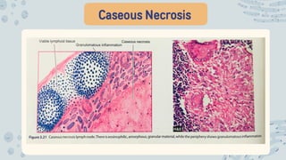 Caseous Necrosis
 