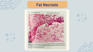 Fat Necrosis
 