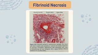 Fibrinoid Necrosis
 