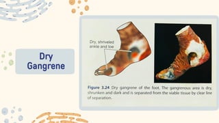 Dry
Gangrene
 