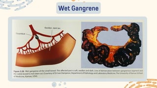 Wet Gangrene
 