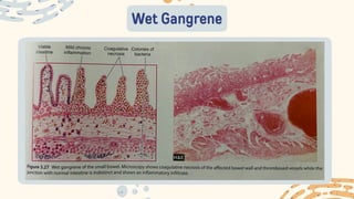 Wet Gangrene
 