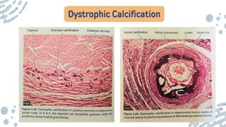 Dystrophic Calcification
 