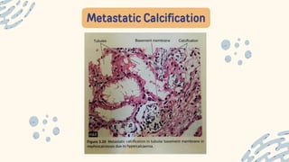 Metastatic Calcification
 
