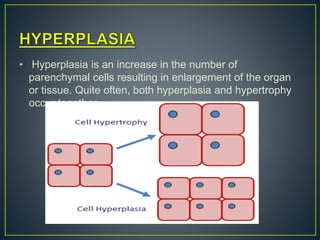 • Hyperplasia is an increase in the number of
parenchymal cells resulting in enlargement of the organ
or tissue. Quite often, both hyperplasia and hypertrophy
occur together.
 