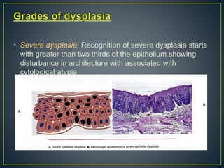 • Severe dysplasia: Recognition of severe dysplasia starts
with greater than two thirds of the epithelium showing
disturbance in architecture with associated with
cytological atypia.
 