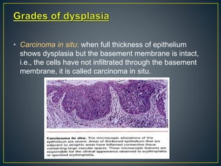 • Carcinoma in situ: when full thickness of epithelium
shows dysplasia but the basement membrane is intact,
i.e., the cells have not infiltrated through the basement
membrane, it is called carcinoma in situ.
 