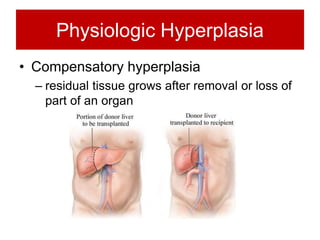 Physiologic Hyperplasia
• Compensatory hyperplasia
– residual tissue grows after removal or loss of
part of an organ
 