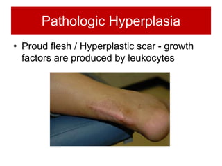 Pathologic Hyperplasia
• Proud flesh / Hyperplastic scar - growth
factors are produced by leukocytes
 