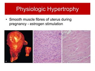 Physiologic Hypertrophy
• Smooth muscle fibres of uterus during
pregnancy - estrogen stimulation
 
