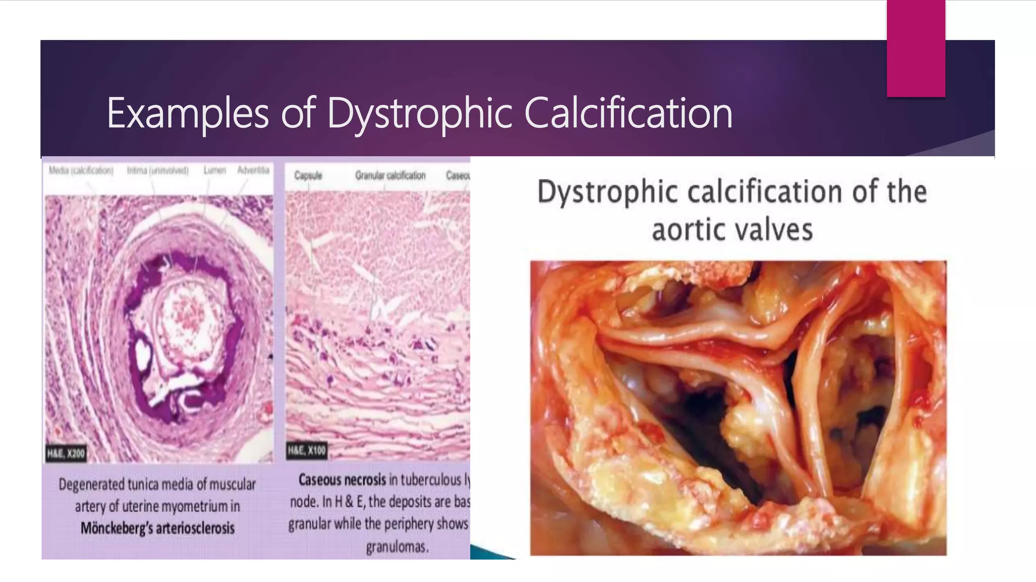 Examples of Dystrophic Calcification
 