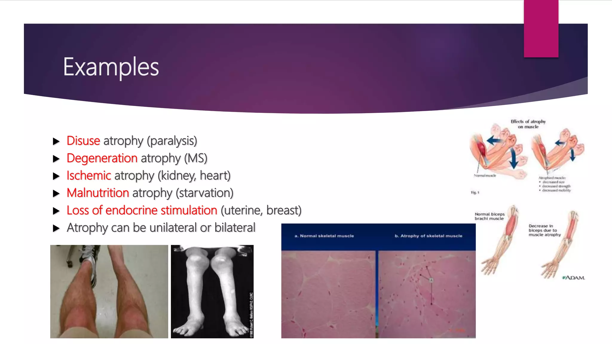 Examples
 Disuse atrophy (paralysis)
 Degeneration atrophy (MS)
 Ischemic atrophy (kidney, heart)
 Malnutrition atrophy (starvation)
 Loss of endocrine stimulation (uterine, breast)
 Atrophy can be unilateral or bilateral
 