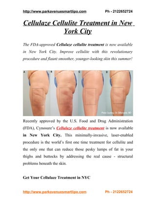 http://www.parkavenuesmartlipo.com                Ph - 2122652724


Cellulaze Cellulite Treatment in New
              York City
The FDA-approved Cellulaze cellulite treatment is now available
in New York City. Improve cellulite with this revolutionary
procedure and flaunt smoother, younger-looking skin this summer!




Recently approved by the U.S. Food and Drug Administration
(FDA), Cynosure’s Cellulaze cellulite treatment is now available
in New York City. This minimally-invasive, laser-enabled
procedure is the world’s first one time treatment for cellulite and
the only one that can reduce those pesky lumps of fat in your
thighs and buttocks by addressing the real cause - structural
problems beneath the skin.


Get Your Cellulaze Treatment in NYC


http://www.parkavenuesmartlipo.com                Ph - 2122652724
 