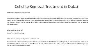 Cellulite Removal Treatment in Dubai
What's going on inside my infant's body?
A port-wine recolor is a kind of skin coloration found in one out of each 200 infants. Likewise called nevus flammeus, it can look pink, dim red, or
purple (like wine, subsequently its name). It is ordinarily level with unpredictable fringes. Port-wine stains are made by little veins that falsehood
near the skin's surface. They are as a rule on the face or neck however can be discovered pretty much anyplace on the body. They are perpetual
skin pigmentations.
What would i be able to do?
You can't and need do nothing.
When does my primary care physician should be included?
Your pediatrician will converse with you about the port-wine recolor. Much of the time, there is nothing to do, no medication to take, and no cream
that should be put on. In any case, on the off chance that the sickness includes one or the two eyes, at that point an ophthalmologist (eye
specialist) should check the eye routinely.
 
