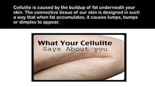 Cellulite Treatment Centre