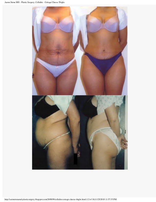 Cellulite Cottage Cheese Thighs
