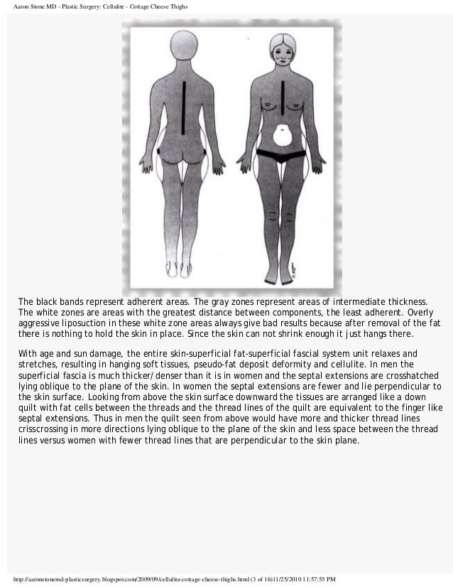 Cellulite cottagecheesethighs