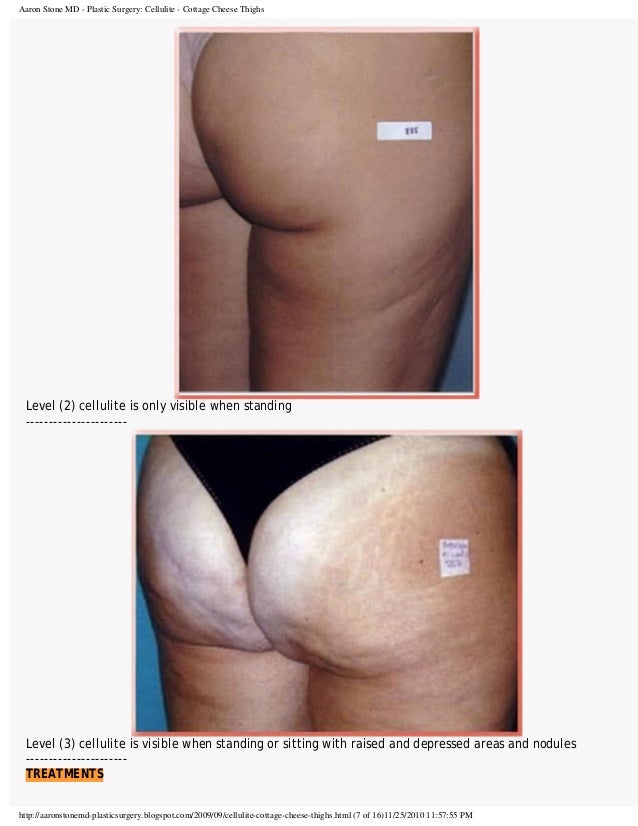 Cellulite Cottage Cheese Thighs