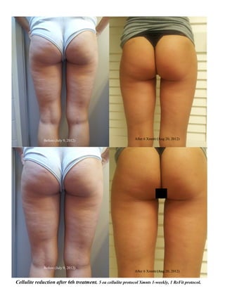 Before (July 9, 2012)                           After 6 Xmnts (Aug 20, 2012)




              Before (July 9, 2012)
                                                              After 6 Xmnts (Aug 20, 2012)


Cellulite reduction after 6th treatment. 5 ea cellulite protocol Xmnts 1-weekly, 1 ReFit protocol.
 