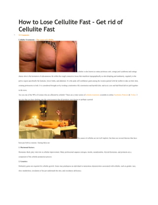 How to Lose Cellulite Fast – Get rid of
Cellulite Fast
11 Comments
Cellulite Treatments – The causes of Cellulite
Cellulite is also known as status protrusus cutis, orange peel syndrome and cottage
cheese skin is the herniation of subcutaneous fat within the rough connective tissue that manifests topographically as skin dimpling and nodularity, regularly in the
pelvic region specifically the buttocks, lower limbs, and abdomen. It is the peak self-confidence giant among the women packed with fat wallets to take on their skin,
creating protrusions to look. It is considered brought on by residing a motionless life constitution and harmful diet, and toxic core and bad blood deliver pull together
in the torso.
Are you one of the 90% of women who are affected by cellulite? There are a wide variety of cellulite treatments available in online Facebook, Pinterest & Twitter. I
am sure that you have dashing into the consciousness that all products your desires or perhaps a period.
The causes of cellulite are not well implicit, but there are several theories that have
been put forth as reasons. Among these are:
1. Hormonal factors:
Hormones likely play vital role in cellulite improvement. Many professional suppose estrogen, insulin, noradrenaline, thyroid hormones, and prolactin are a
component of the cellulite production process.
2. Genetics:
Definitely genes are required for cellulite growth. Genes may predispose an individual to meticulous characteristics associated with cellulite, such as gender, race,
slow metabolism, circulation of fat just underneath the skin, and circulatory deficiency.
 